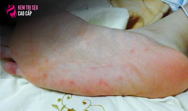 Hướng Dẫn Chi Tiết Cách Chà Tỏi Lên Lòng Bàn Chân và Những Lưu Ý Quan Trọng